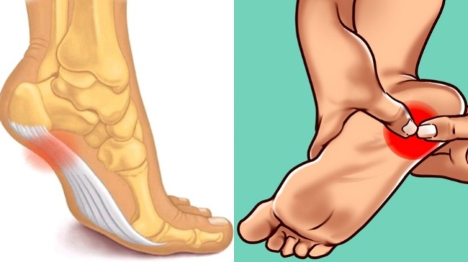 pelmatiaia-aponeyrositida-symptomata-antimetopisi-kai-prolipsi-tis-epiponis-pathisis-toy-pelmatos-47749