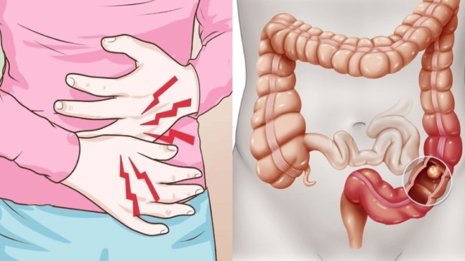polypodas-pacheos-enteroy-simantiki-i-egkairi-diagnosi-amp-8211-ta-6-athoa-symptomata-amp-8211-poioi-kindyneyoyn-perissotero-47835