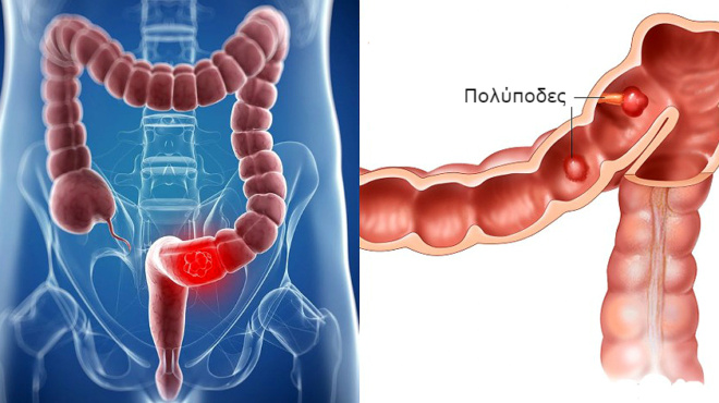 karkinos-sto-entero-poia-ta-ypopta-symptomata-amp-8211-pos-epireazetai-apo-ti-diatrofi-amp-8211-ti-prepei-na-kanete-76799