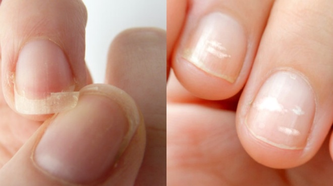 12-ypoyla-symptomata-sta-nychia-poy-syndeontai-me-alles-pathiseis-kai-me-poies-trofes-antimetopizontai-48697