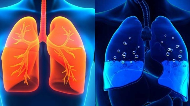 pneymoniko-oidima-pos-tha-katalavete-an-echei-syssoreytei-ygro-stoys-pneymones-kai-ti-prepei-na-kanete-amesa-66665