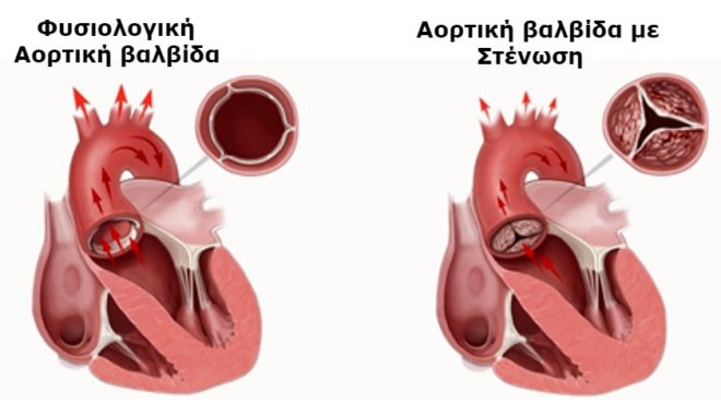 stenosi-aortikis-valvidas-3-simadia-kampanakia-poy-deichnoyn-provlima-stin-kardia-kai-den-prepei-na-agnoisete-73341
