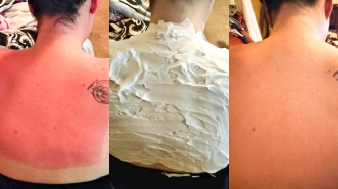 egkayma-apo-ton-ilio-ti-prepei-na-kaneis-amesa-pos-feygei-o-ponos-pote-einai-epikindyno-32624