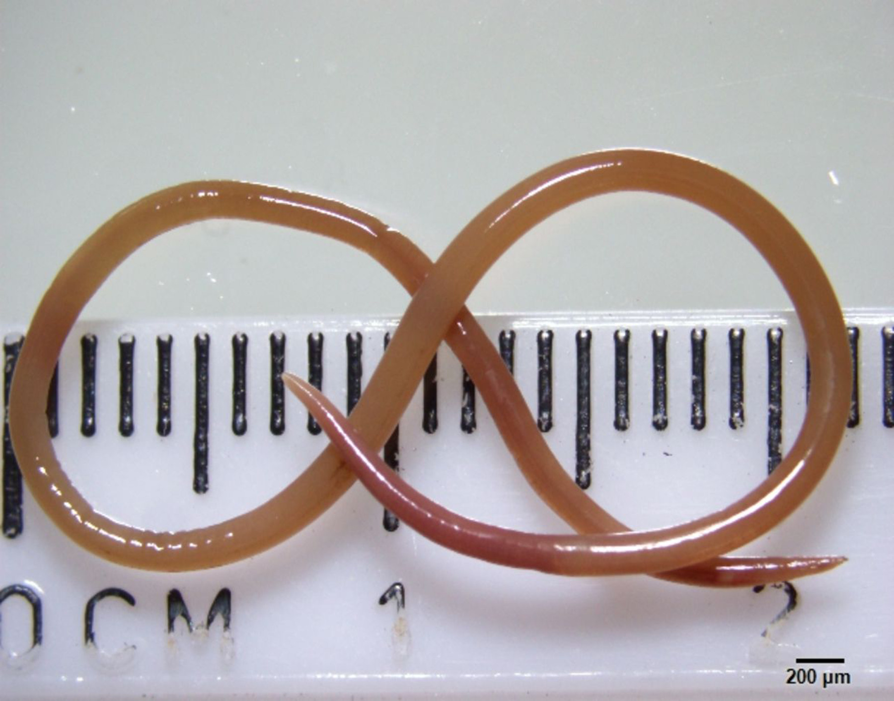 64χρονη με σκουλήκι 8 εκατοστών 