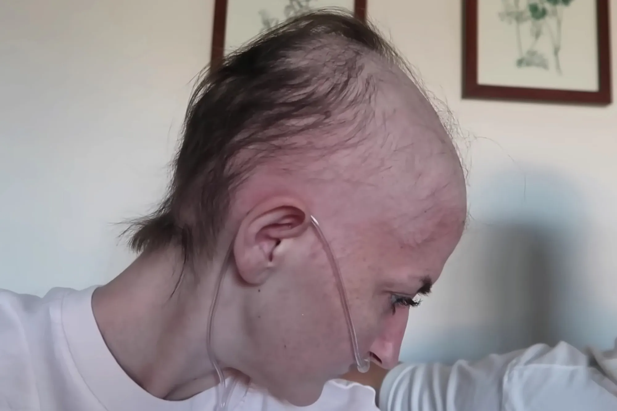 Καρκινοπαθής μητέρα έβαλε τα παιδιά της να την ξυρίσουν 