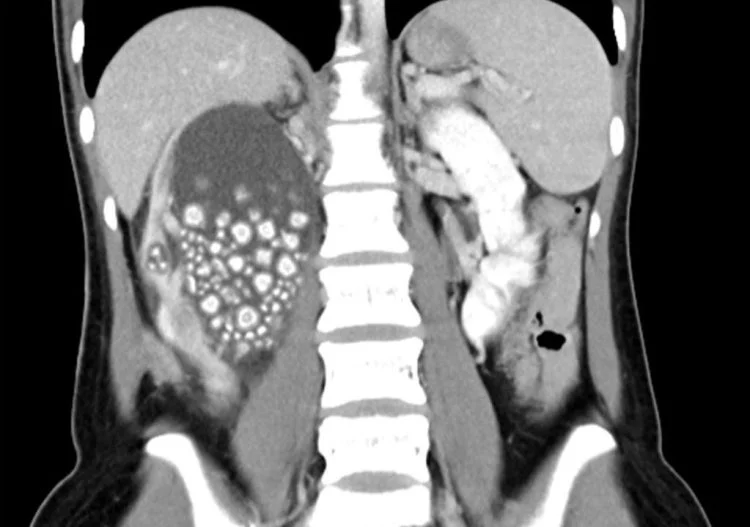 20χρονη είχε 300 πέτρες στα νεφρά 