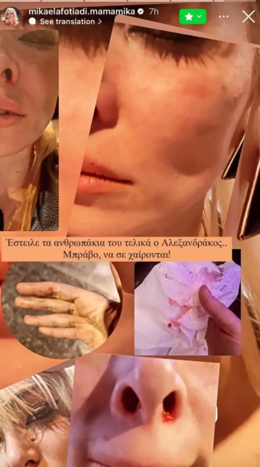 Θύμα ξυλοδαρμού η Μικαέλα Φωτιάδη