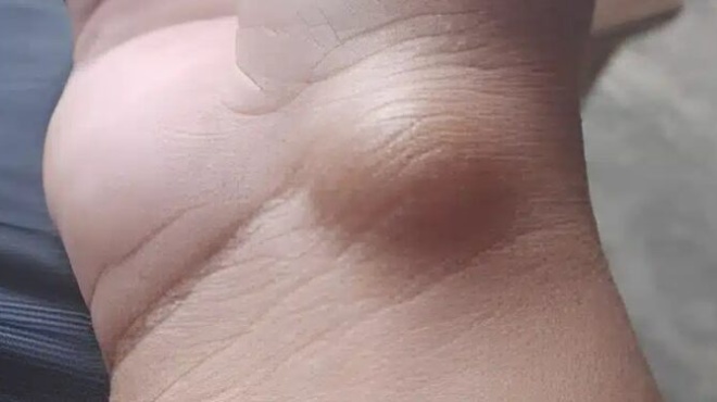 to-exogkoma-poy-mporei-na-emfanistei-apo-kati-poy-kanete-kathe-mera-amp-8211-ti-symptomata-prokaloyn-kai-poia-i-antimetopisi-toys-375623