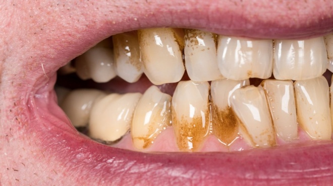 5-symvoyles-gia-na-afairesete-eykola-tin-petra-apo-ta-dontia-382184