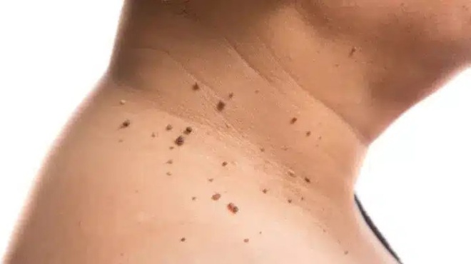 ligoi-to-xeroyn-etsi-tha-afairesete-tis-kreatoelies-apo-to-soma-sas-amp-8211-giati-emfanizontai-eidika-sto-laimo-kai-stis-maschales-397600