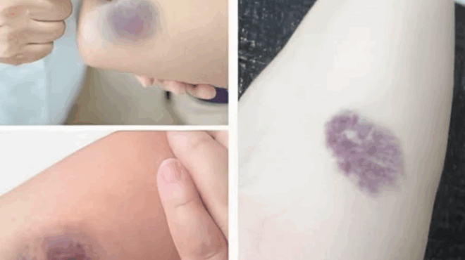 prosochi-an-emfanistoyn-tetoies-melanies-sto-soma-sas-simainei-oti-echete-407993