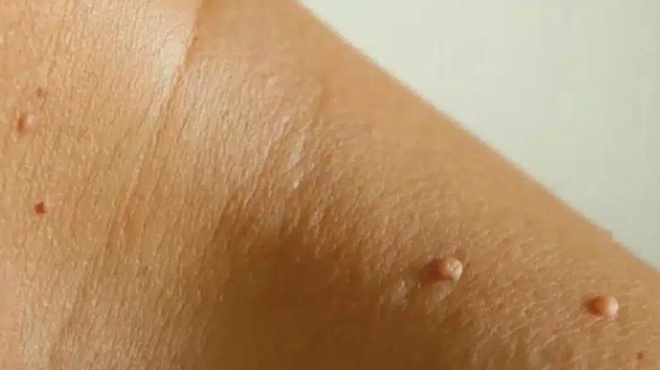 giati-emfanizontai-sarkodeis-elies-sto-laimo-i-stis-maschales-moy-kai-pos-mporo-na-tis-afaireso-oi-eidikoi-exigoyn-407433