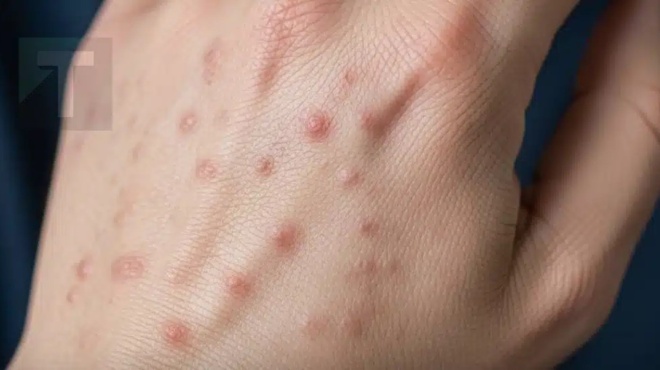 oi-giatroi-proeidopoioyn-an-echete-aytes-tis-mikres-kokkines-koykkides-sto-cheri-sas-min-agnoisete-ta-proeidopoiitika-simadia-408303