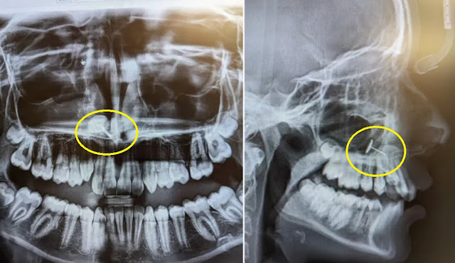 mitera-pige-tin-kori-tis-ston-odontiatro-gia-mia-aktinografia-roytinas-ayto-poy-apokalyfthike-tin-afise-afoni-403192