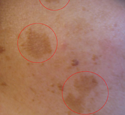 kilides-sto-prosopo-giati-emfanizontai-kai-pos-tha-tis-antimetopisoyme-403776