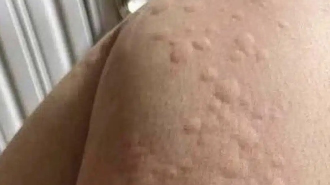 na-eiste-prosektikoi-an-sas-troei-to-soma-kai-emfanistoyn-ayta-ta-exogkomata-sto-derma-sas-405574