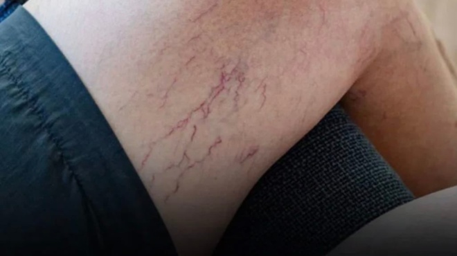 fleves-sta-podia-poy-ginontai-mov-na-ti-prepei-na-gnorizete-407454