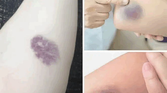 prosochi-an-emfanistoyn-tetoies-melanies-sto-soma-sas-simainei-oti-echete-409025