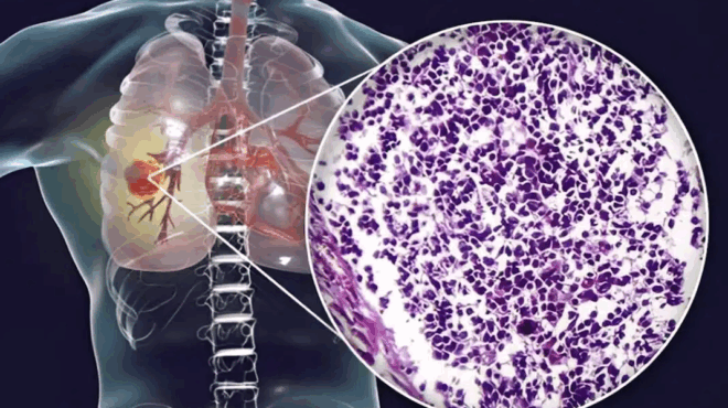 o-aoratos-kindynos-ti-koino-yliko-koyzinas-syndeetai-me-karkino-pneymona-prosochi-sto-spiti-sas-415468