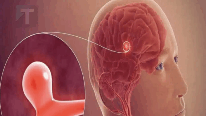 ta-12-simadia-poy-soy-dinei-to-soma-soy-kai-mporei-na-ypodilonoyn-aneyrysma-egkefaloy-amp-8211-to-1-to-echoyn-schedon-oloi-amp-8211-min-ta-agnoiseis-422688
