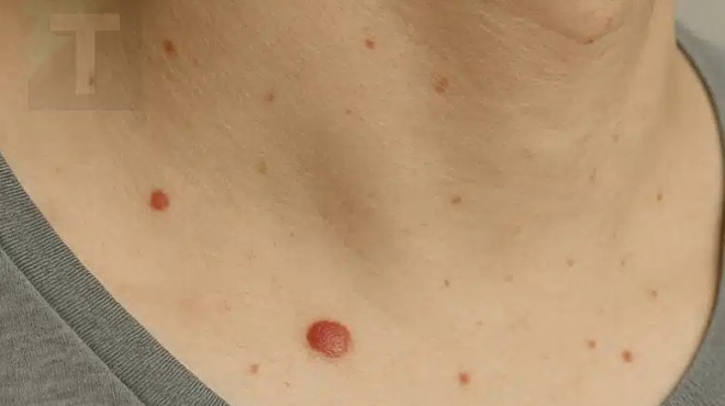 giati-emfanizontai-kokkines-kreatoelies-sto-derma-deite-ti-leei-i-epistimi-432105