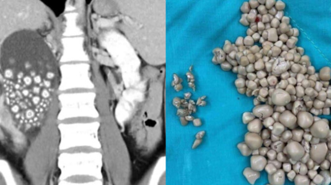 afonoi-oi-giatroi-me-tis-petres-poy-vrikan-ston-nefro-20chronis-den-epine-katholoy-nero-mono-chymoys-kai-tsai-foto-428700