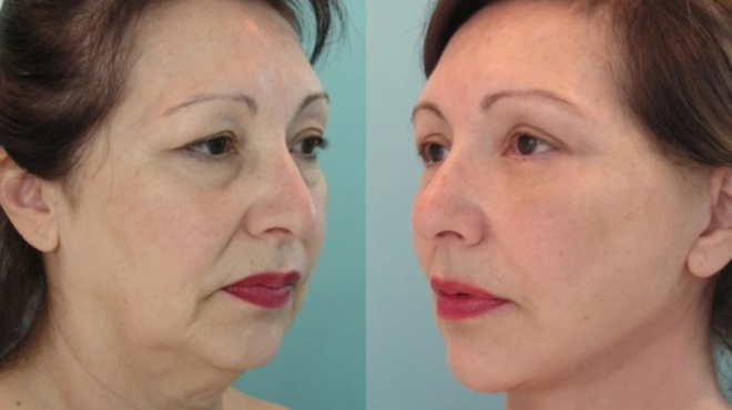 exafaniste-rytides-deixte-20-chronia-neoteres-2-ylika-poy-sigoura-echete-sto-spiti-sas-amp-038-svnnoyn-ta-snmadia-tis-gnransis-434163