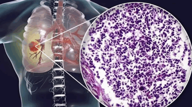 o-aoratos-kivduvos-ti-koino-yliko-koyzinas-syndeetai-me-kapkivo-pneymona-pposoxn-sto-spiti-sas-429988