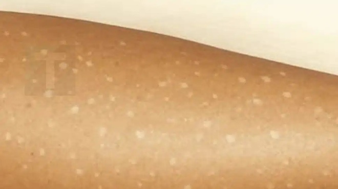 leykes-kilides-sto-derma-poies-elleipseis-vitaminon-mporei-na-einai-i-aitia-440954