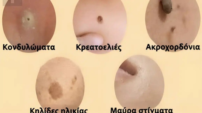 antimetopiste-fysika-kilides-kreatoelies-myrmigkies-kai-mayra-stigmata-442272