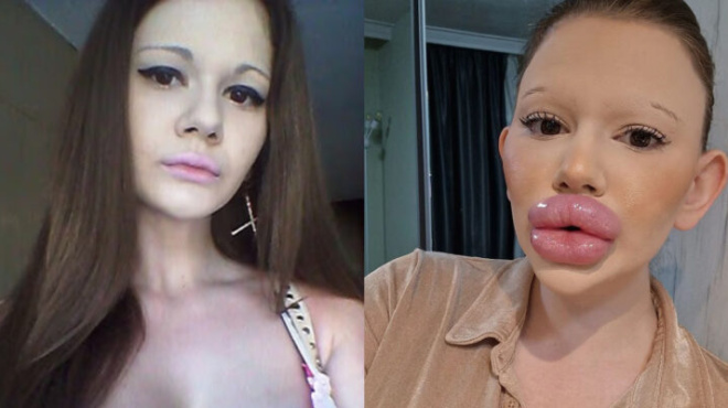 24chroni-ethismeni-stis-plastikes-parafoyskose-ta-cheili-tis-egine-san-papia-kai-pisteyei-pos-einai-kai-koyklara-amp-8230-deite-tin-442506