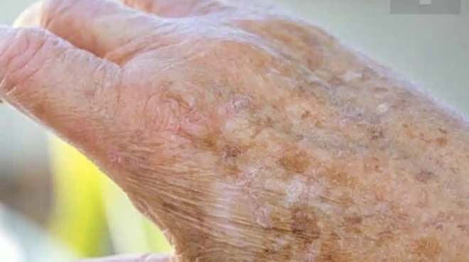 giati-emfanizontai-kilides-sta-cheria-mas-kai-pos-mporoyme-na-tis-exaleipsoyme-436160