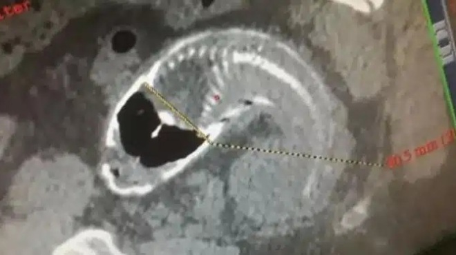 30chronos-eiche-aforitoys-ponoys-sto-stomachi-ayto-poy-vrikan-sto-entero-toy-sokape-toys-giatroys-434729