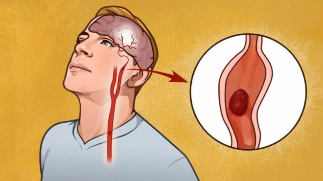 thymitheite-ta-archika-apchk-opoios-kanei-ayta-ta-4-pragmata-meionei-kata-80-tin-pithanotita-na-pathei-egkefaliko-amp-8211-des-poia-439548