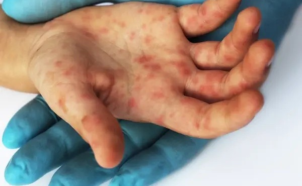 gemizei-exanthimata-olo-soy-to-soma-psinesai-ston-pyreto-saronei-i-nea-epidimia-ayxanontai-dramatika-ta-kroysmata-449264