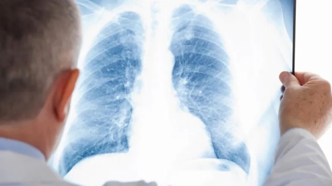 gripi-a-otan-o-ios-metakomizei-stoys-pneymones-ta-krisima-simadia-poy-deichnoyn-pneymonia-450982