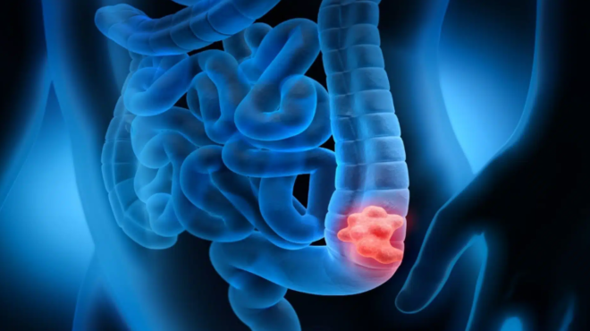 simadia-karkinoy-toy-pacheos-enteroy-ta-symptomata-poy-den-prepei-na-agnoisete-443593