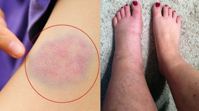 thromvosi-ti-tha-niosete-molis-sas-symvei-6-symptomata-poy-prepei-na-anagnorisete-egkairos-445726