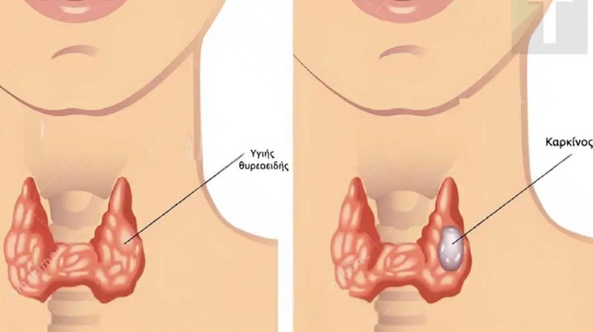 oi-periptoseis-karkinoy-toy-thyreoeidoys-auxanontai-ragdaia-oi-giatroi-sas-symvoyleyoyn-na-trote-ligotero-apo-aytes-tis-trofes-447438