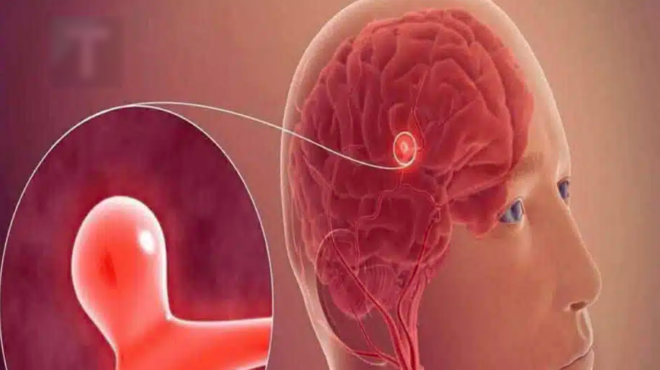 aneyrysma-simadia-kai-symptomata-poy-den-prepei-na-agnoisete-454183