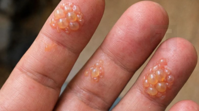 ta-dachtyla-toy-syzygoy-einai-kalymmena-me-aytes-tis-mikroskopikes-foyskales-neroy-den-mporei-kan-na-pliktrologisei-gia-ti-doyleia-455064