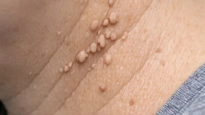 ayta-ta-mikra-dermatika-thilomata-emfanizontai-synechos-gyro-apo-ton-laimo-moy-kai-den-tha-do-ton-giatro-moy-gia-evdomades-ti-mporo-na-kano-amesa-453685