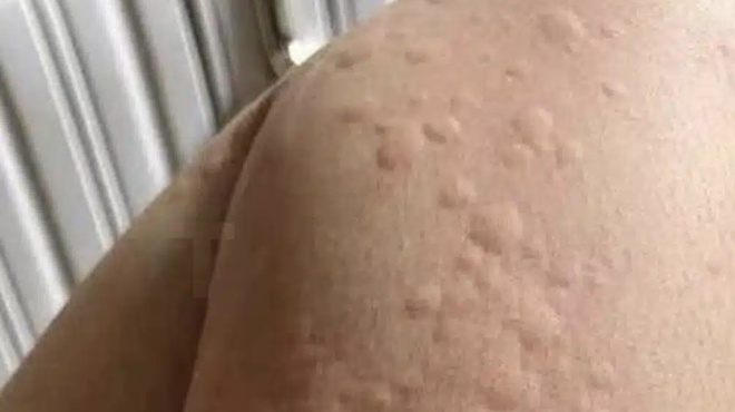 giati-emfanizontai-pomfoi-sto-derma-aytoi-einai-oi-aprosmenoi-paragontes-poy-isos-den-gnorizete-459124