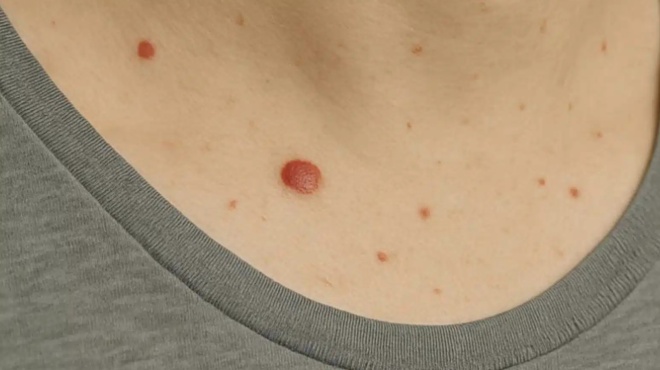 giati-emfanizontai-kokkines-elies-sto-derma-ti-leei-i-epistimi-461275