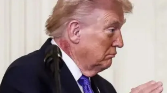 pagkosmia-anisychia-gia-tin-ygeia-toy-ntonalnt-tramp-ti-simainei-to-exanthima-poy-echei-sto-laimo-toy-458946