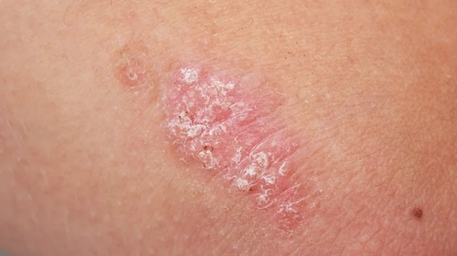 echete-psoriasi-prosochi-se-aytes-tis-6-trofes-mporei-na-epideinonoyn-ta-symptomata-choris-na-to-katalavainete-513646